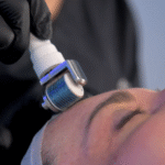 A close-up of a microneedling or derma roller treatment being applied to a woman's forehead by a professional wearing black gloves, in a clinical or aesthetic setting.