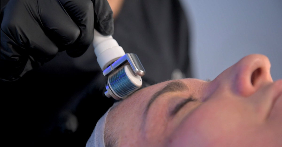 A close-up of a microneedling or derma roller treatment being applied to a woman's forehead by a professional wearing black gloves, in a clinical or aesthetic setting.