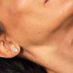 Aesthetic injection in a woman’s neck, with a fine needle inserted into the skin under the chin, performed by a practitioner wearing black gloves