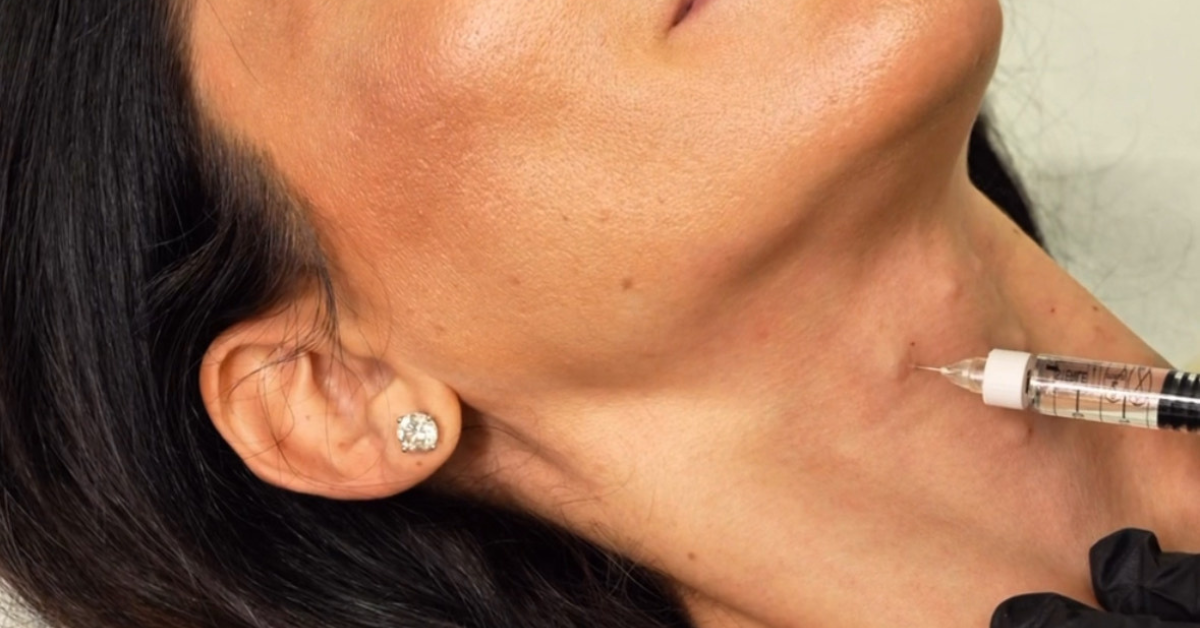Aesthetic injection in a woman’s neck, with a fine needle inserted into the skin under the chin, performed by a practitioner wearing black gloves